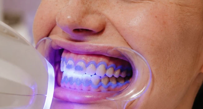 Sesión de blanqueamiento dental en consultorio