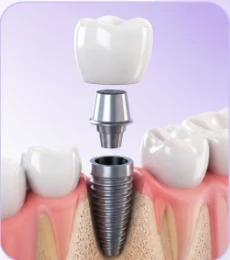 Diagrama de implante dental con perno, pilar y corona